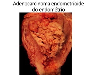 Adenocarcinoma endometrioide
do endométrio
 