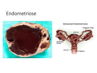 Endometriose
 
