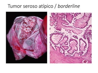 Tumor seroso atípico / borderline
 