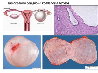 Tumor seroso benigno (cistoadenoma seroso)
 