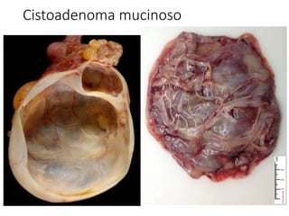 Cistoadenoma mucinoso
 