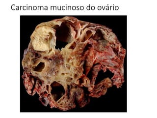 Carcinoma mucinoso do ovário
 