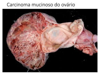 Carcinoma mucinoso do ovário
 