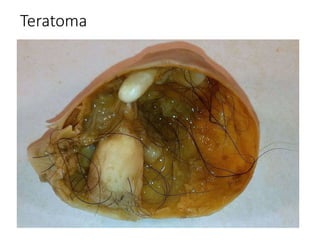 Teratoma
 