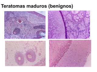 Teratomas maduros (benignos)
 