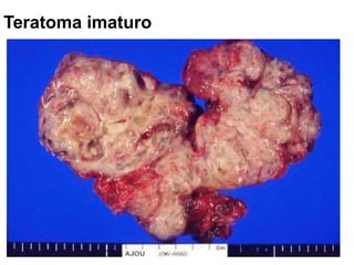 Teratoma imaturo
 