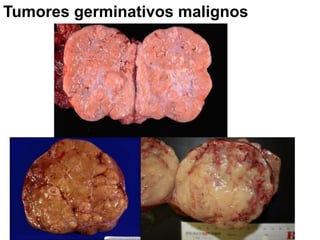 Tumores germinativos malignos
 