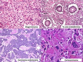 Disgerminoma Tu seio endodérmico
Carcinoma embrionário Coriocarcinoma
 