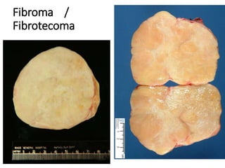 Fibroma /
Fibrotecoma
 