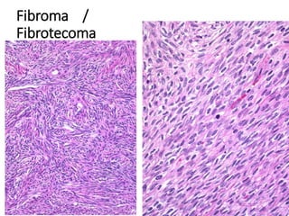 Fibroma /
Fibrotecoma
 