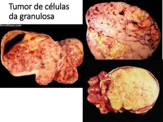 Tumor de células
da granulosa
 