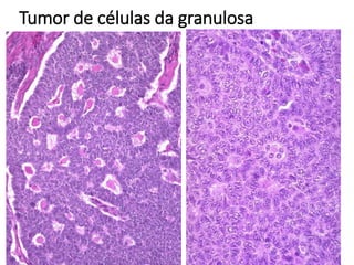 Tumor de células da granulosa
 
