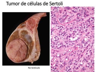 Tumor de células de Sertoli
No testículo
 