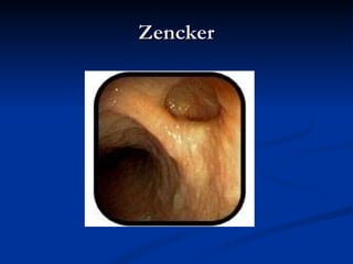 Zencker 