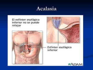 Acalasia 