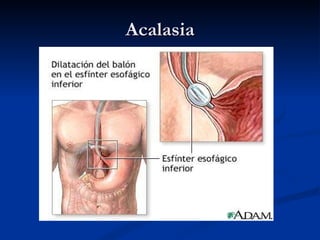 Acalasia 