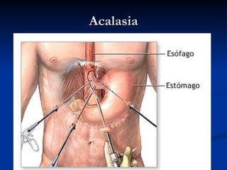 Acalasia
