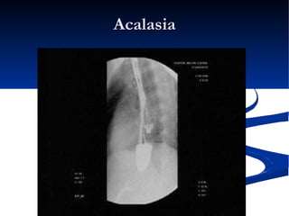 Acalasia