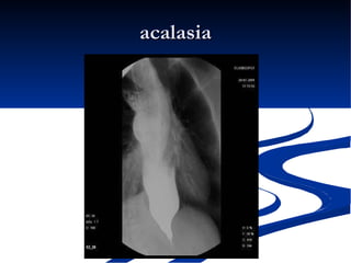 acalasia 
