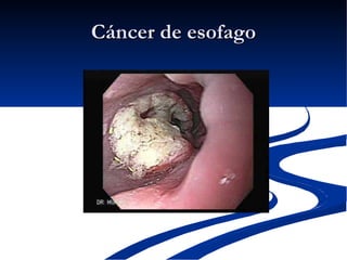 Cáncer de esofago 