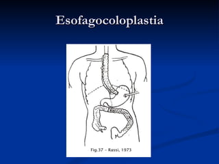 Esofagocoloplastia 