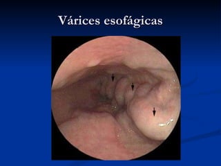 Várices esofágicas 