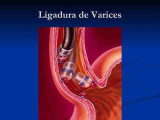 Ligadura de Varices