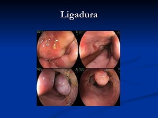 Ligadura 