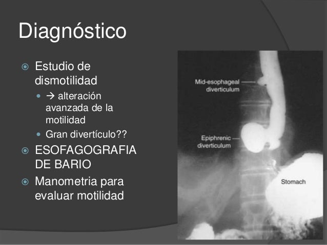 PATOLOGÍA ESOFÁGICA: ACALASIA, DIVERTÍCULOS ESOFÁGICOS Y PATOLOGÍA ESOFÁGICA: ACALASIA, DIVERTÍCULOS ESOFÁGICOS Y