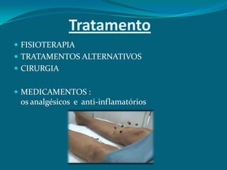 Tratamento
 FISIOTERAPIA
 TRATAMENTOS ALTERNATIVOS
 CIRURGIA
 MEDICAMENTOS :

os analgésicos e anti-inflamatórios

 
