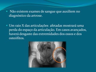  Não existem exames de sangue que auxiliem no

diagnóstico da artrose.
 Um raio X das articulações afetadas mostrará uma

perda do espaço da articulação. Em casos avançados,
haverá desgaste das extremidades dos ossos e dos
osteófitos.

 