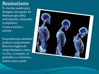 Reumatismo
É o termo usado para
designar um grupo de
doenças que afeta
articulações, músculos
e esqueleto.
Como a artrite e
artrose .
Essas doenças também
podem comprometer
diversos órgãos do
corpo humano, como
os rins, o coração, os
pulmões e o intestino,
assim como a pele.

 