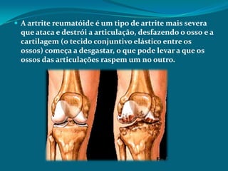 A artrite reumatóide é um tipo de artrite mais severa

que ataca e destrói a articulação, desfazendo o osso e a
cartilagem (o tecido conjuntivo elástico entre os
ossos) começa a desgastar, o que pode levar a que os
ossos das articulações raspem um no outro.

 