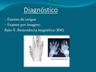 Diagnóstico
• Exames de sangue
• Exames por imagem:

Raio-X ,Ressonância magnética (RM)

 