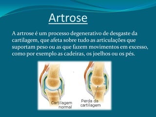 Artrose
A artrose é um processo degenerativo de desgaste da
cartilagem, que afeta sobre tudo as articulações que
suportam peso ou as que fazem movimentos em excesso,
como por exemplo as cadeiras, os joelhos ou os pés.

 