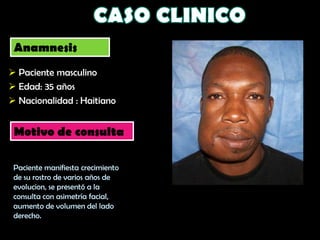 Anamnesis
 Paciente masculino
 Edad: 35 años
 Nacionalidad : Haitiano


 Motivo de consulta

 Paciente manifiesta crecimiento
 de su rostro de varios años de
 evolucion, se presentó a la
 consulta con asimetría facial,
 aumento de volumen del lado
 derecho.
 