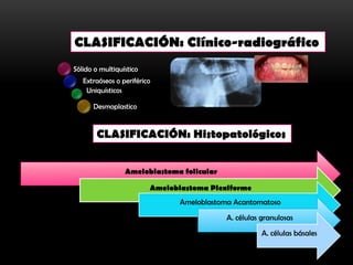 CLASIFICACIÓN: Clínico-radiográfico
Sólido o multiquístico
   Extraóseos o periférico
    Uniquísticos

      Desmoplastico


       CLASIFICACIÓN: Histopatológicos


                 Ameloblastoma folicular

                         Ameloblastoma Plexiforme
                                Ameloblastoma Acantomatoso
                                            A. células granulosas
                                                       A. células básales
 