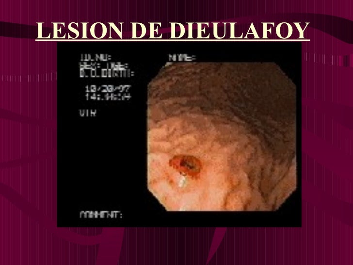 Cáncer Gástrico