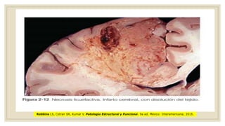 Robbins LS, Cotran SR, Kumar V. Patología Estructural y Funcional. 9a ed. México: Interamericana; 2015.
 