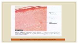 Mohan H., Patología, 6ª ed., Editorial Médica Panamericana, Buenos Aires, 2012
 