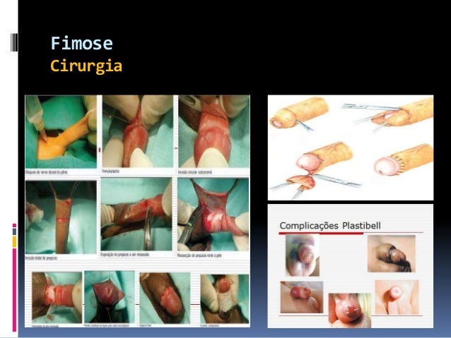 Patologia Genital Masculina Benigna Patologia Genital Masculina Benigna
