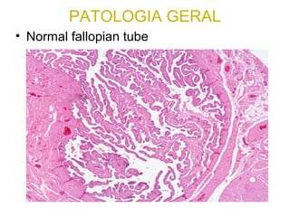 PATOLOGIA GERAL
• Normal fallopian tube
 