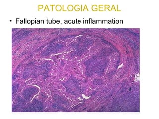 PATOLOGIA GERAL
• Fallopian tube, acute inflammation
 