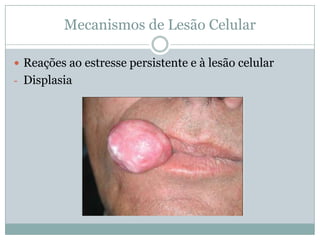 Mecanismos de Lesão Celular
 Reações ao estresse persistente e à lesão celular
- Displasia
 