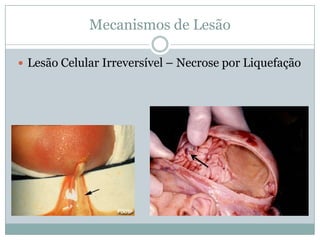 Mecanismos de Lesão
 Lesão Celular Irreversível – Necrose por Liquefação
 