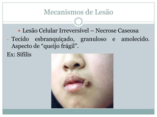Mecanismos de Lesão
 Lesão Celular Irreversível – Necrose Caseosa
- Tecido esbranquiçado, granuloso e amolecido.
Aspecto de “queijo frágil”.
Ex: Sífilis
 