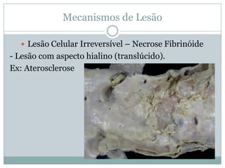 Mecanismos de Lesão
 Lesão Celular Irreversível – Necrose Fibrinóide
- Lesão com aspecto hialino (translúcido).
Ex: Aterosclerose
 