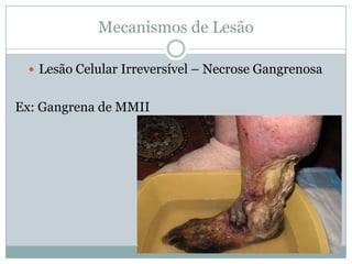 Mecanismos de Lesão
 Lesão Celular Irreversível – Necrose Gangrenosa
Ex: Gangrena de MMII
 