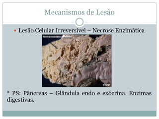 Mecanismos de Lesão
 Lesão Celular Irreversível – Necrose Enzimática
* PS: Pâncreas – Glândula endo e exócrina. Enzimas
digestivas.
 