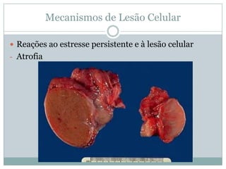 Mecanismos de Lesão Celular
 Reações ao estresse persistente e à lesão celular
- Atrofia
 